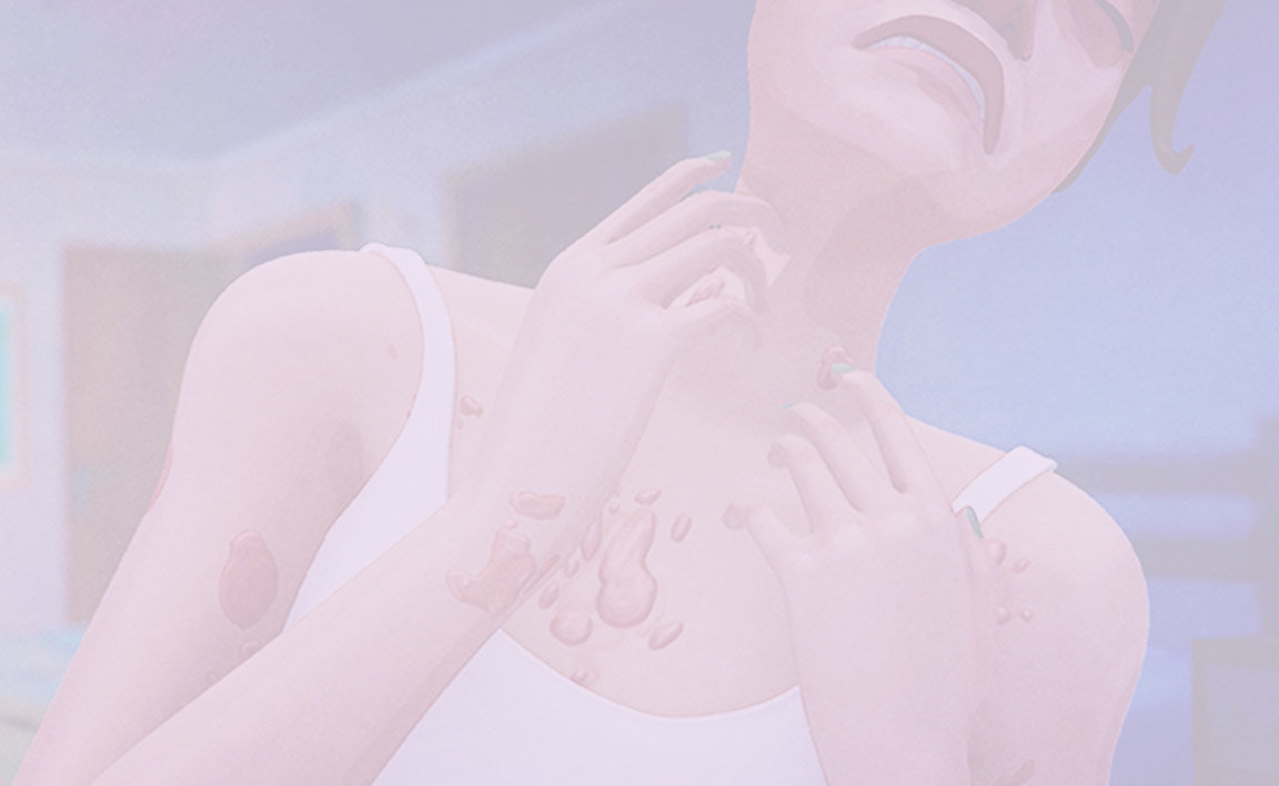 Closeup of woman with hives scratching her neck